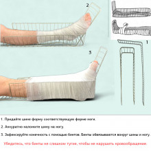 Проволочная шина Крамера для ног